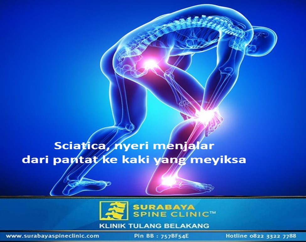 Sciatica, Linu Menjalar dari Pantat ke Kaki 